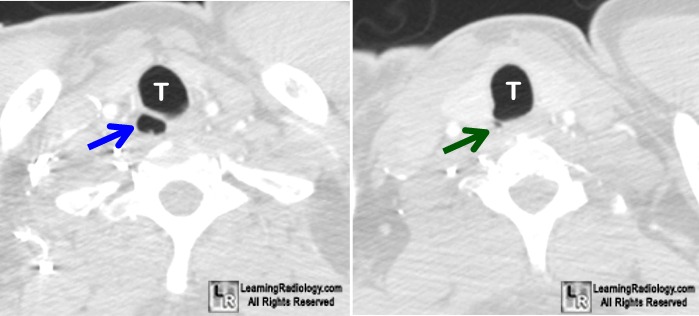 paratracheal air cyst